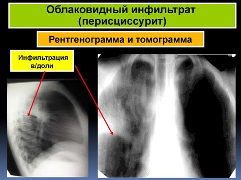 Очаговый туберкулез - презентация онлайн