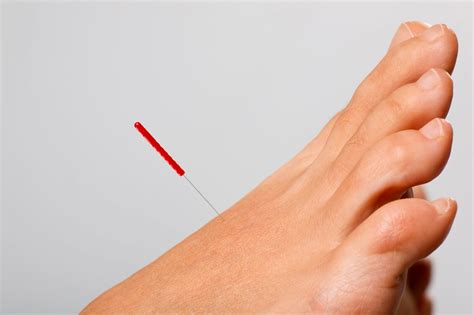 Dry Needling - Moreland Podiatry