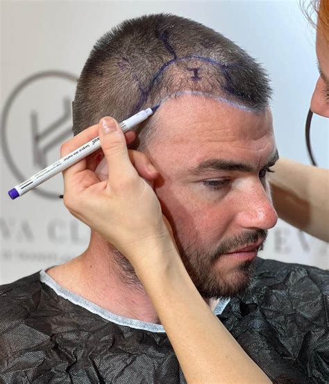diffuse thinning hair transplant procedure cost heva clinic