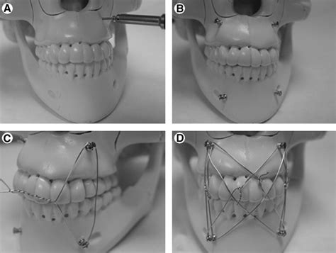 techniques  maxillary mandibular fixation operative techniques