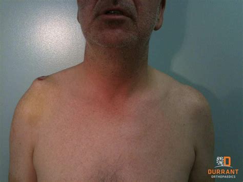 AC Joint Seperations and Injuries a Patients Guide