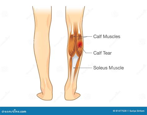 calf muscle tear stock vector illustration  hard