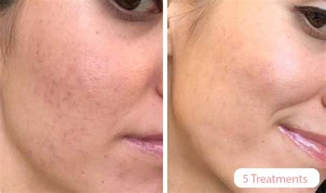 Microdermabrasion Rejuvenation Kit – Makefullbeauty