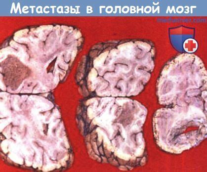 Метастазы опухоли в головной мозг - патология, морфология