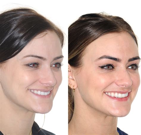 Wearing Invisalign Before And After