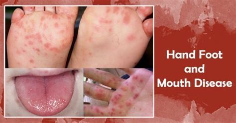 Hand Foot Mouth Disease Rash Symptoms - Infoupdate.org