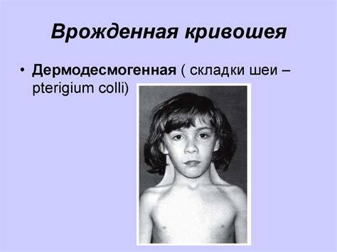 Врожденная мышечная кривошея - презентация онлайн