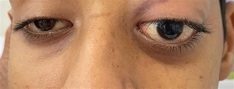 photograph   eyes demonstrating apparent left eye proptosis