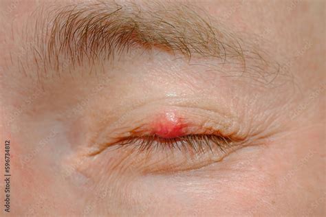 Eyelid sickness. Demodicosis mite diseas, demodex. Chalazion on eyelid ...