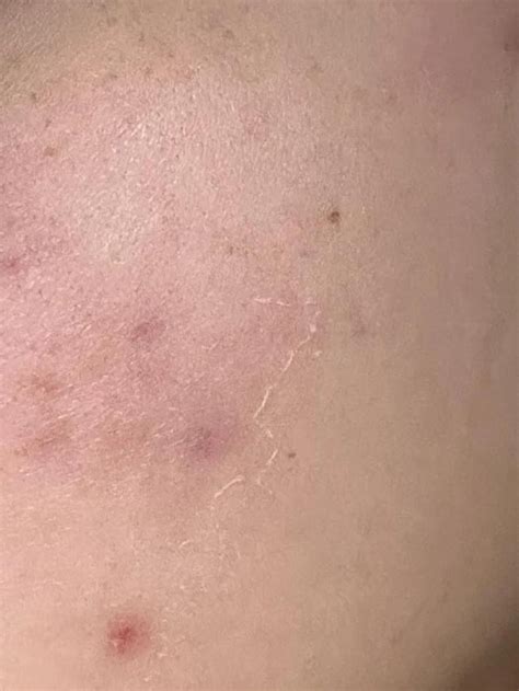 [acne] does retinol cause skin peeling? : r/SkincareAddiction