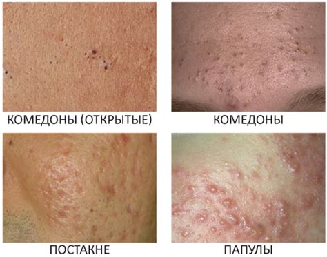 Виды акне. Какие бывают и как их отличить | SKINORMIL