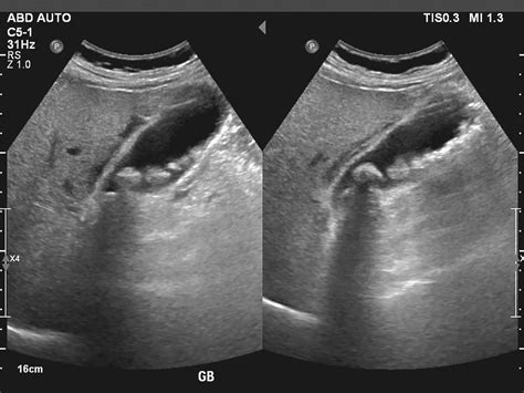 Gallbladder Stones in Singapore | Alpha Digestive & Liver Centre
