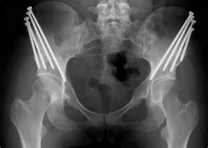 Periacetabular Osteotomy (PAO) for Acetabular Dysplasia St. Louis, MO | Open Hip Dislocation ...