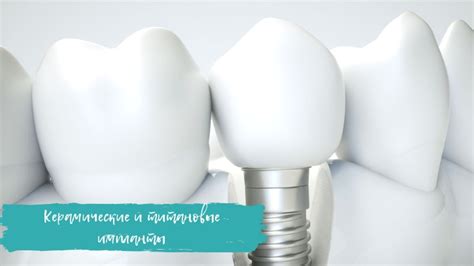 Керамические и титановые импланты | Стоматология в Праге dSmile
