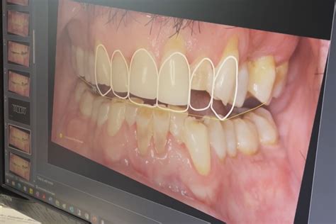 How to Treat Worn Down Teeth - Summit Dental & Orthodontics