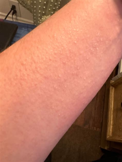Crusted Scabies?? : r/scabies
