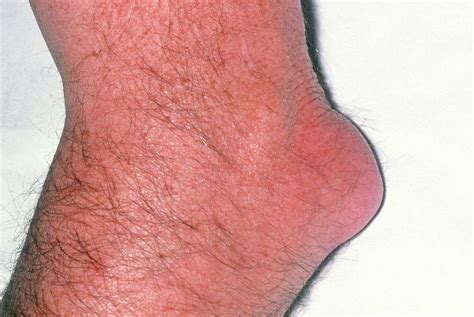 Olecranon Bursitis (student's Elbow) Photograph by Dr P. Marazzi ...