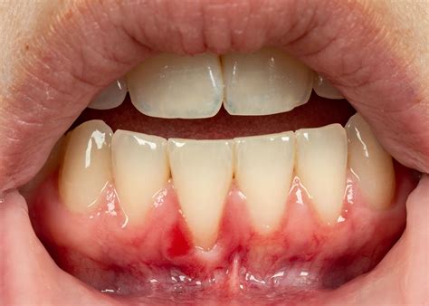 I healed my receding gums