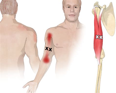 The Biceps Brachii Muscle, Its Attachments and Actions - Yoganatomy