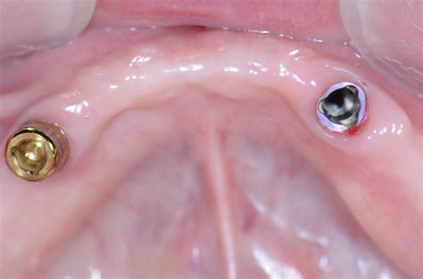 Planning for Future Implants - Lee Ann Brady, DMD's Dental Blog