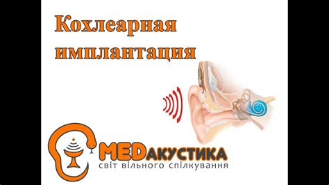 Кохлеарная имплантация - YouTube