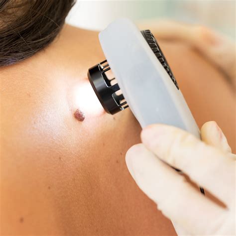 Lumps, Bumps and Moles - Yuma Dermatology