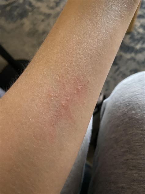 Does drinking alcohol make your post scabbies treatment worse? : r/scabies