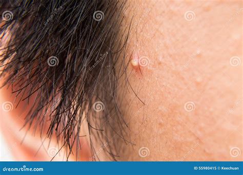 Teenager With Pimples On His Face Stock Photography | CartoonDealer.com ...