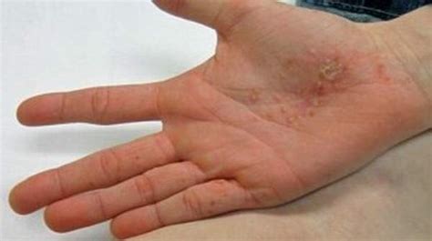 Dyshidrotic Eczema Symptoms and Treatment