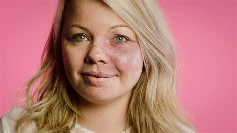 K1, J1: Tervetuloa vastaanotolle | Iho ja itsetunto | Yle Areena
