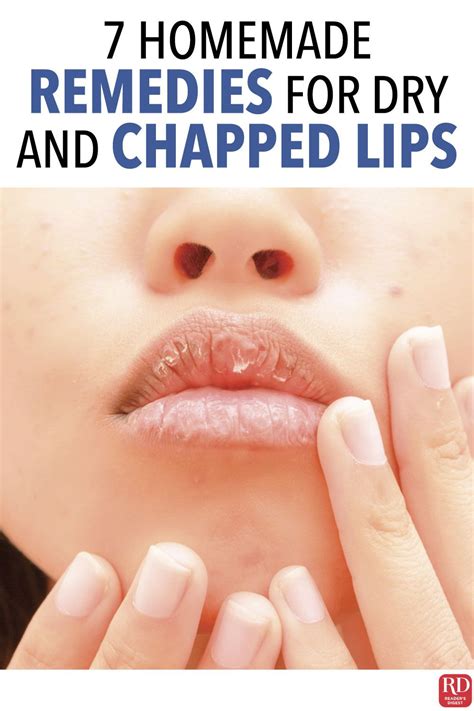 7 Homemade Remedies for Dry and Chapped Lips | Dry lips remedy, Chapped ...