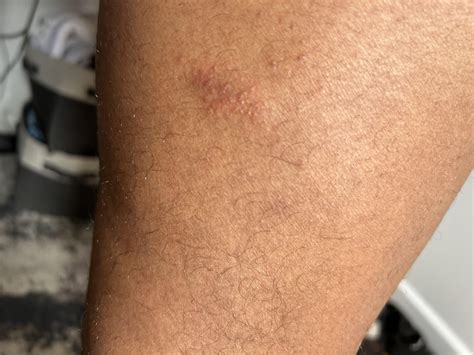 Itchy rash under thigh has gotten worse : r/medical