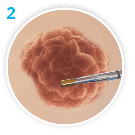 MOLLI re.markable – MOLLI Surgical