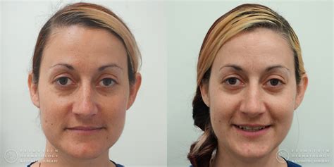 Forever Young® BBL + HALO® Laser | Feinstein Dermatology