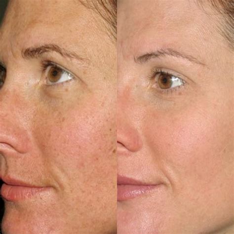 IPL (BBL) Laser Skin Treatment — Tahoe Injectables + Aesthetics Medical Spa