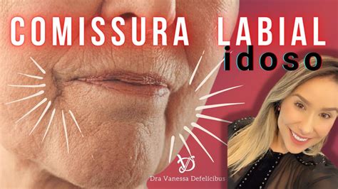 Desvio De Comissura Labial