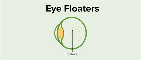 Are Eye Floaters a Serious Vision Problem?