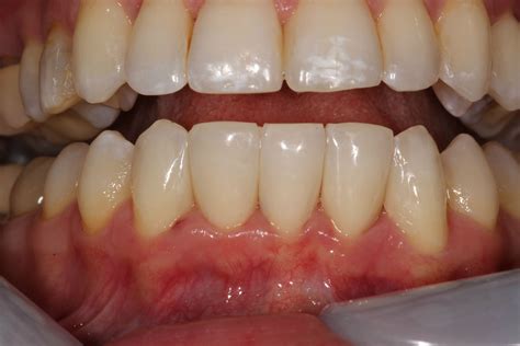how to fix a chipped tooth at home 11