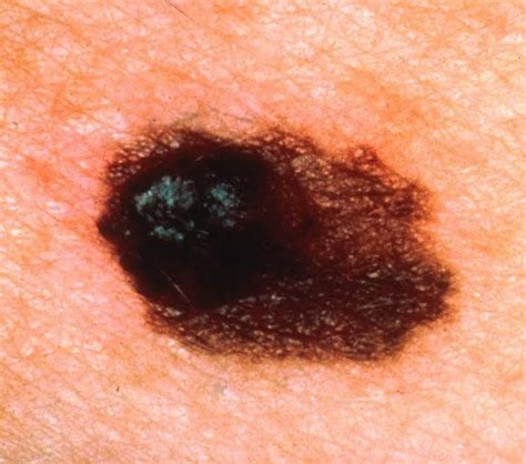 nodular melanoma