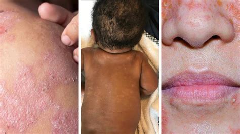 GET RID OF ECZEMA, ACNE FAST, #eczema #nappyrash #acne #skincare - YouTube