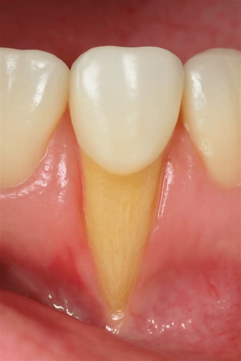 Raiz Do Dente Exposta - Raiz do Dente Exposta: Causas e Soluções - MAXICLIN