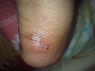 atsebijak minda berfikir sains sukan bagaimana melecet  berlaku