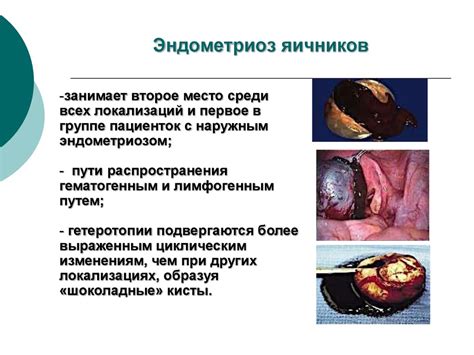 Эндометриоз. Распространенность эндометриоза - презентация онлайн