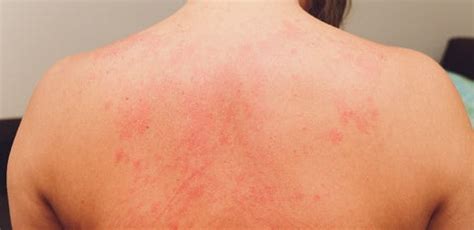 DYSHIDROTIC ECZEMA TREATMENT – Delfina Skin™