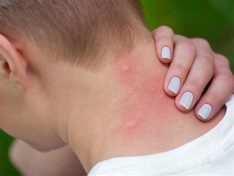 9 Bug Bite Pictures - How To Identify Common Types Of Bug Bites