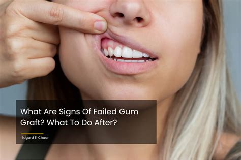 signs  failed gum graft