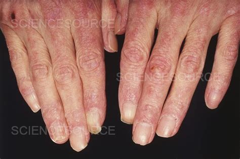 Photograph | Dermatomyositis | Science Source Images