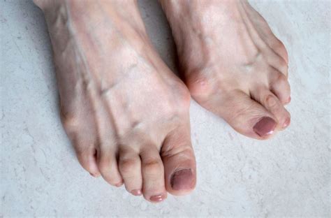 Ugly Feet Surgery - Everything You Need to Know