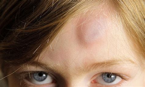 Атерома: фото, на голове, за ухом, на спине, лечение, удаление