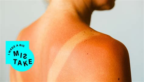 treat sunburn popular science